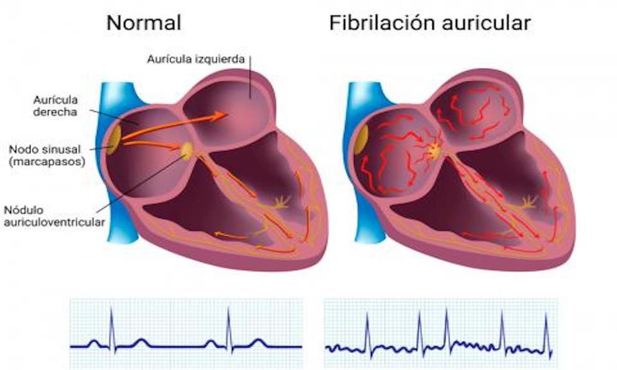 Que Es Fibrilacion Auricular C Est Quoi Une Acfa XICHUC